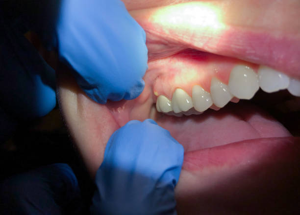 Best Emergency Denture Repair in White Horse, NJ